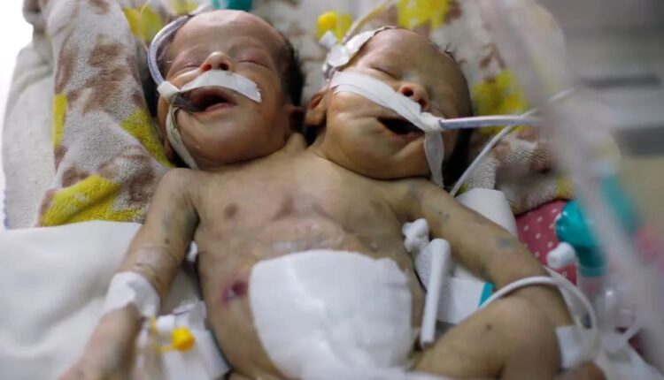 شاهد| السعودية تشهد ولادة توأم سيامي بصدر واحد وقلبين