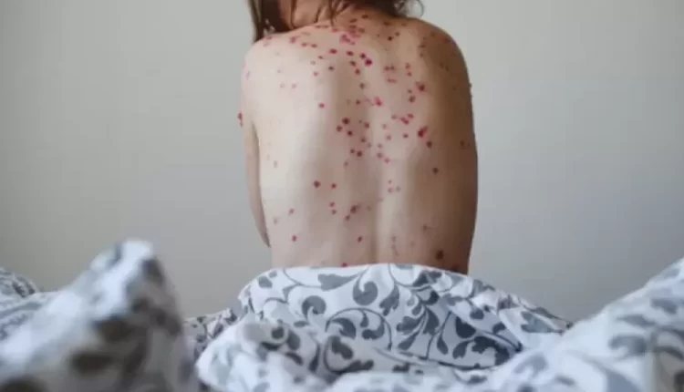 تسجيل أول إصابة بجدري القرود في قارة آسيا.. الإمارات قلقة كثيرا