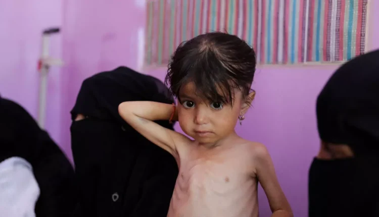 اليمن: انتشار سوء التغذية الحاد في المناطق الخاضعة لسيطرة الحكومة