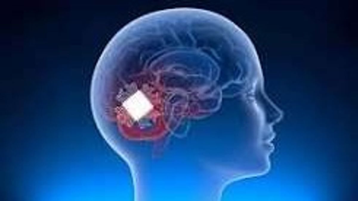 ابتكار شريحة دماغية أمريكية تعيد الكلام والبلع لضحايا إصابات المخ