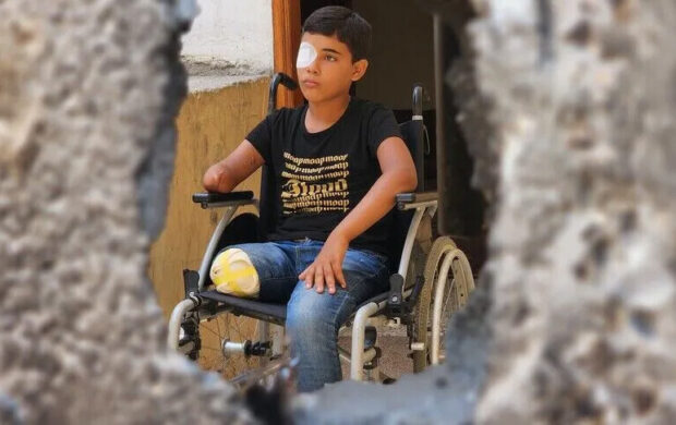 المرصد الأورومتوسطي: 10 آلاف طفل فقدوا ساقا و9 قتلى من كل 10 مدنيون في غزة
